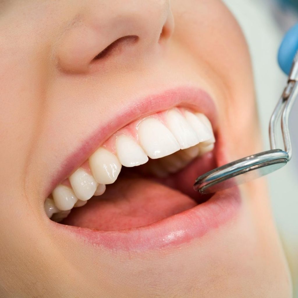 caries dentales tratamiento